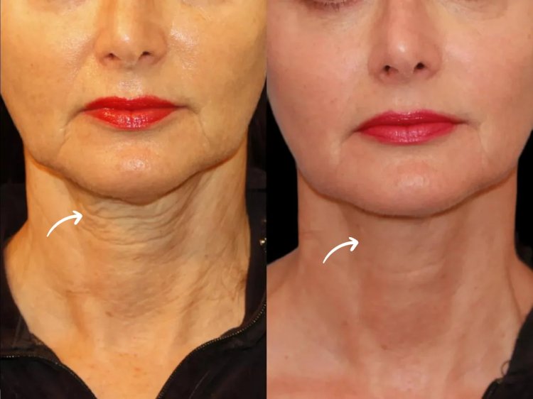 How Sculptra Helps Achieve a More Youthful Appearance: Advice from the Best Plastic Surgeons in dubai