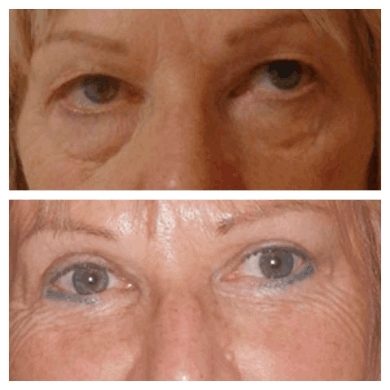 The Role of Experience in Choosing the Best Eye bag removal Surgeon in dubai